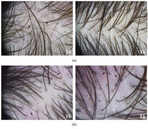 Detalhe do couro cabeludo e diferenças de densidade dos fios.