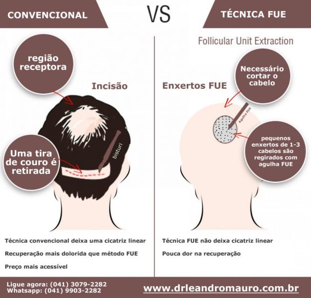 transplante-capilar-sem-cicatriz-tecnica-fue