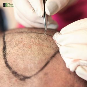 Transplante Capilar FUE em Curitiba Resultado Natural e Reconstrução da HairLine