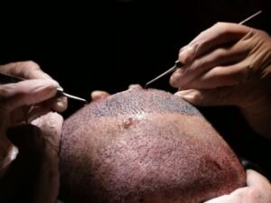 Transplante Capilar FUE ajuda a reduzir o Tamanho da Testa