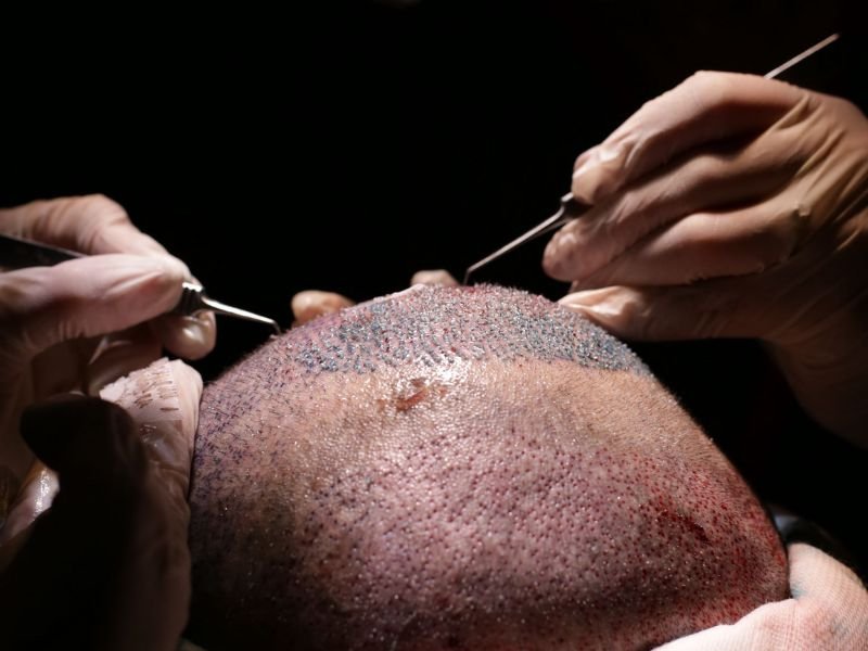 Transplante Capilar FUE ajuda a reduzir o Tamanho da Testa