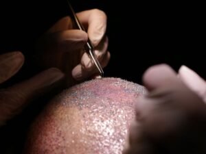 Meus Cabelos Estao Caindo e Agora