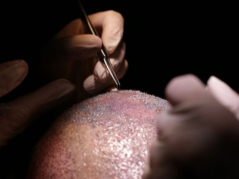 Meus Cabelos Estao Caindo e Agora