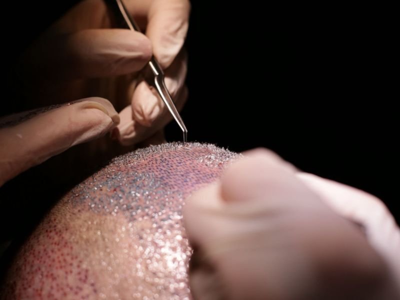 O que Fazer no Pre Operatorio de Transplante Capilar