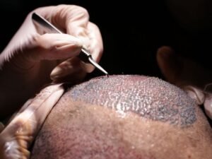 O que e Transplante Capilar e Qual a Diferenca Para Implante Capilar