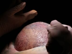 A evolucao do transplante capilar em Curitiba tecnologias e tecnicas mais avancadas