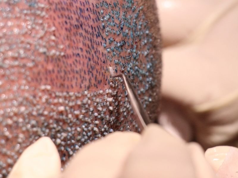 Transplante Capilar em Curitiba Por Que Escolher o Dr. Leandro Mauro