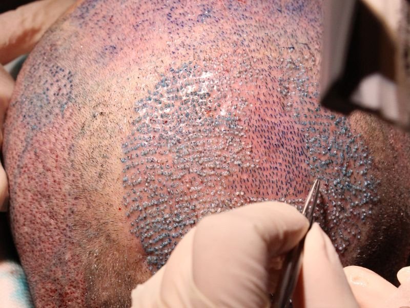 Como Funciona o Transplante Capilar