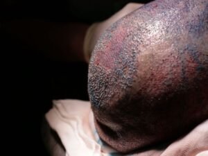 Acompanhamento Pos Operatorio em Transplantes Capilares em Curitiba 1