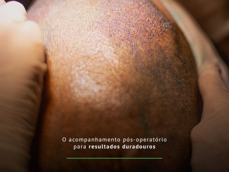 Acompanhamento Pós-Operatório em Transplantes Capilares em Curitiba