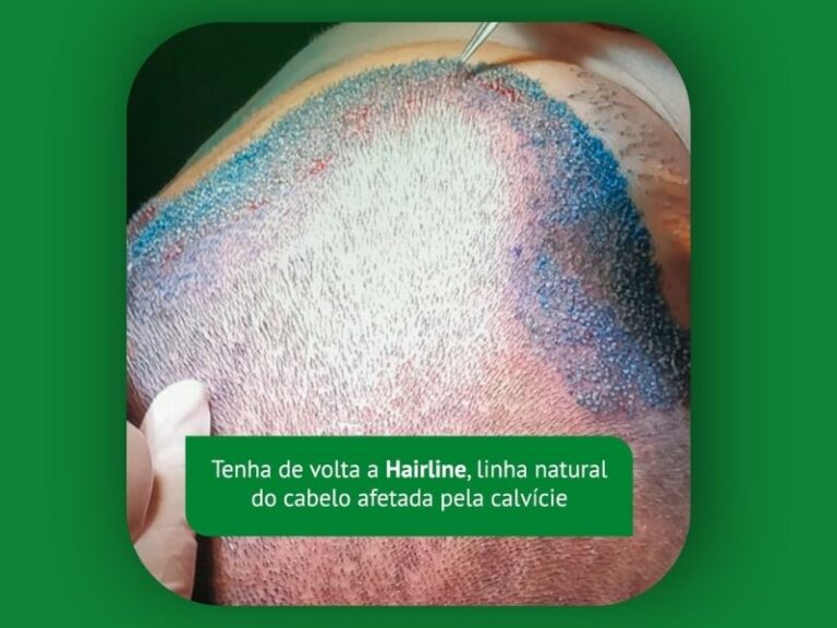 Recupere Sua Hairline com o Transplante Capilar em Curitiba