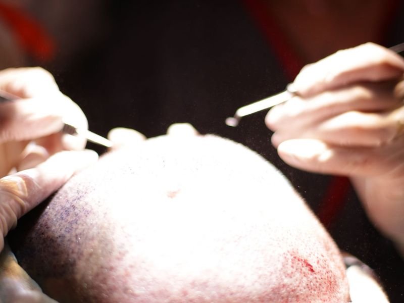 O Processo de Implantacao no Transplante Capilar em Curitiba