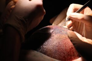 Inovações no Transplante Capilar Uso da Anestesia e Técnicas Avançadas