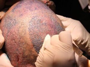 Retorno ao Trabalho e Vida Cotidiana Apos Transplante Capilar