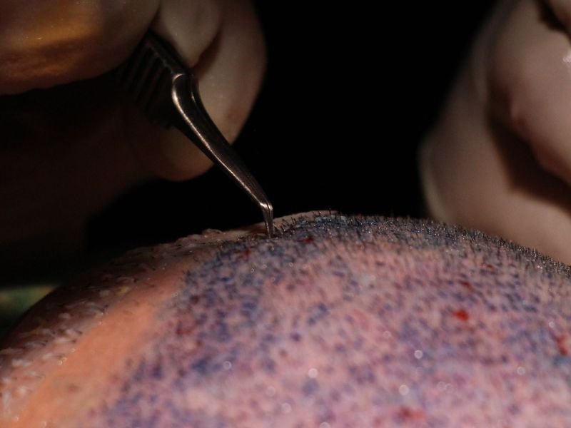 Transplante Capilar em Curitiba Tratamento Seguro para Calvicie Masculina