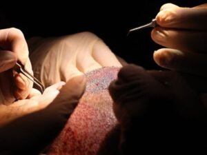 Procedimento Seguro de Transplante Capilar FUE em Curitiba