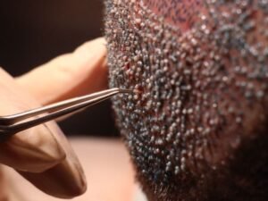 Transplante de Cabelo e Barba em Curitiba Solucoes Avancadas