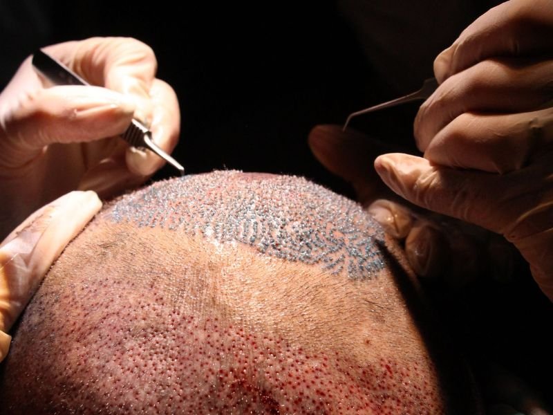 De Onde Sao Retirados os Fios para Transplante Capilar