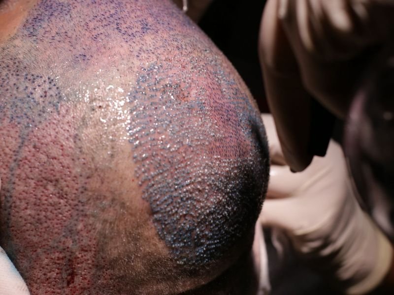 Transplante Capilar em Curitiba Fios Definitivos e Crescimento Garantido