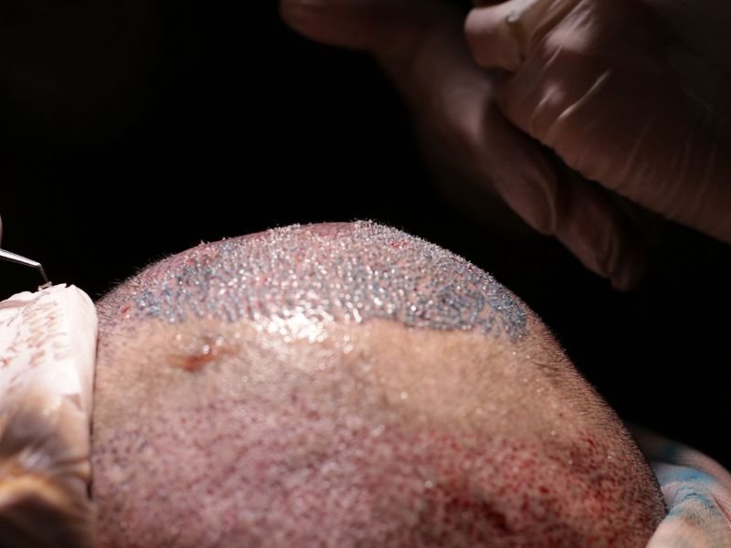 Transplante Capilar FUE e FUT Procedimentos Menos Invasivos em Curitiba
