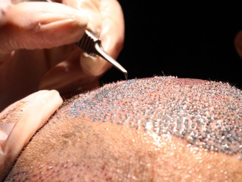 Transplante Capilar em Curitiba Entenda as Tecnicas FUE e FUT