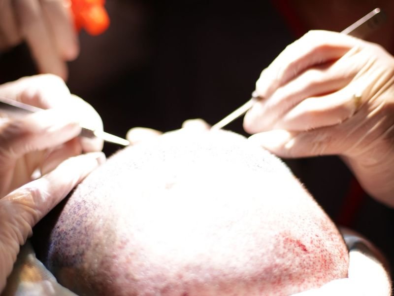 Recupere Sua Autoestima com o Transplante Capilar em Curitiba