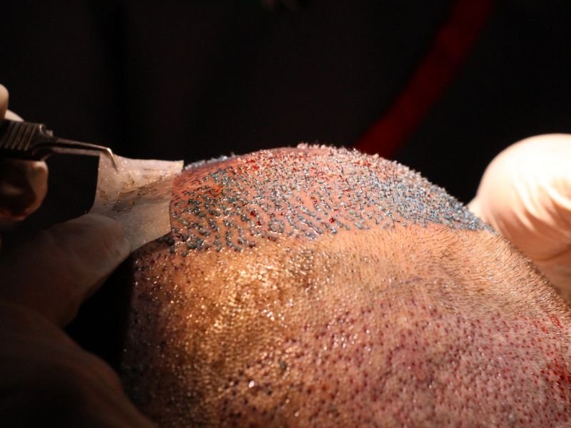 Cirurgia de Transplante Capilar Resultado Natural com a Tecnica FUE