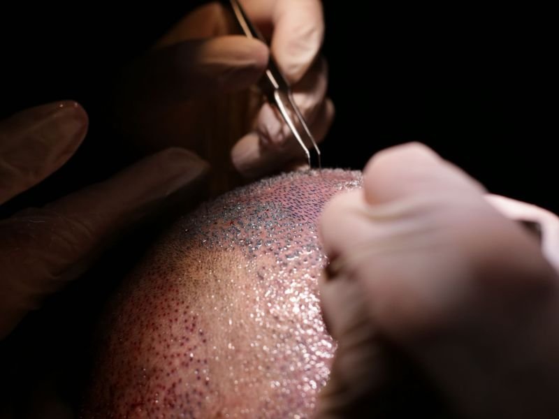 Transplante Capilar em Curitiba O Que Esperar da Recuperacao Pos Operatoria