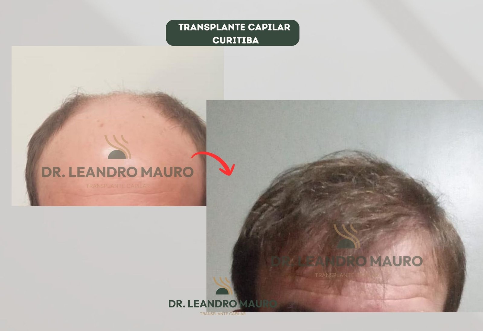 Antes e Depois do Transplante Capilar em Curitiba A Evolucao Real de um Paciente
