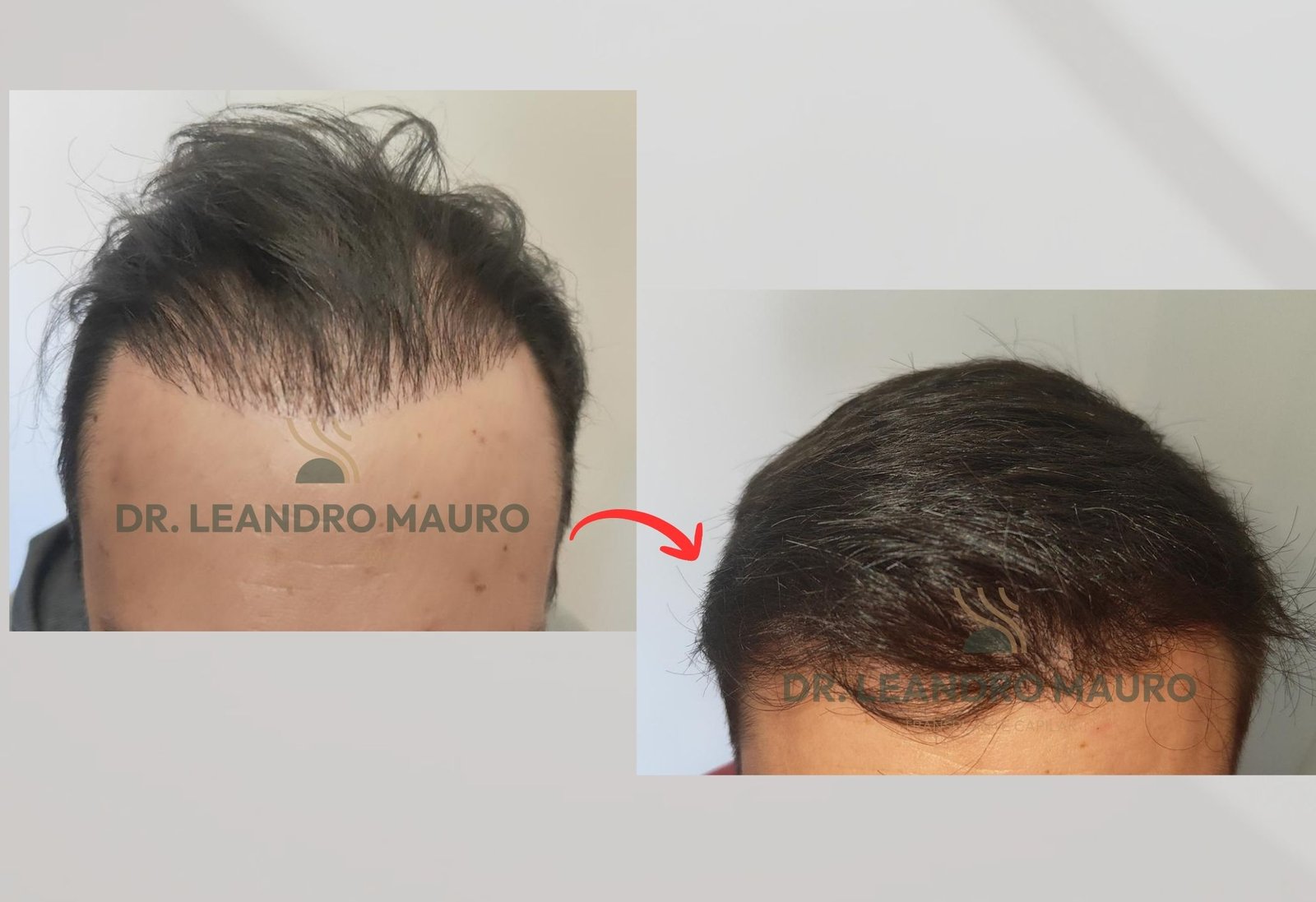 Curitiba como Referencia em Transplante Capilar Tecnologia Estrutura e Recuperacao Segura