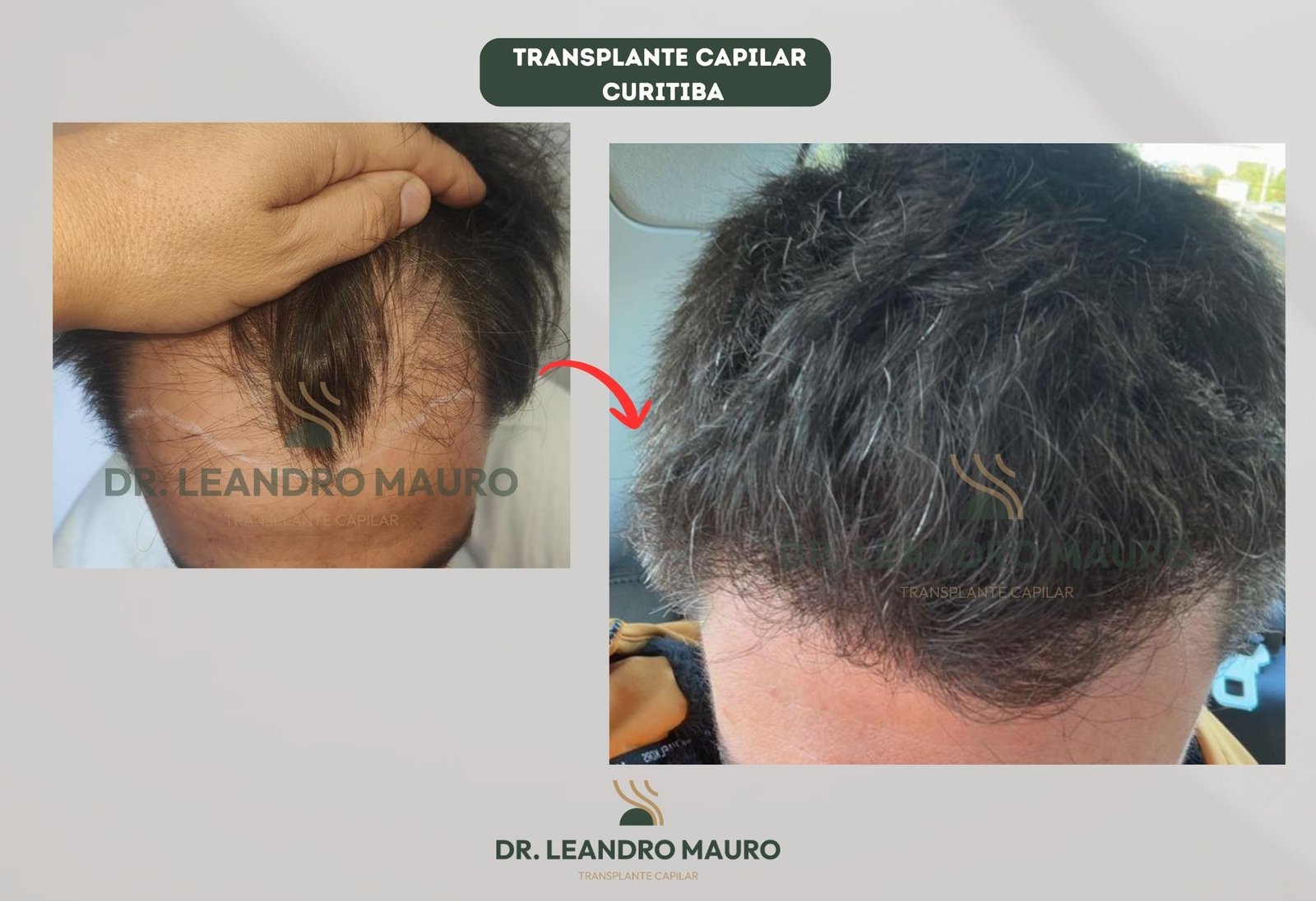 Diagnostico ao Resultado Final Como Funciona o Transplante Capilar em Curitiba