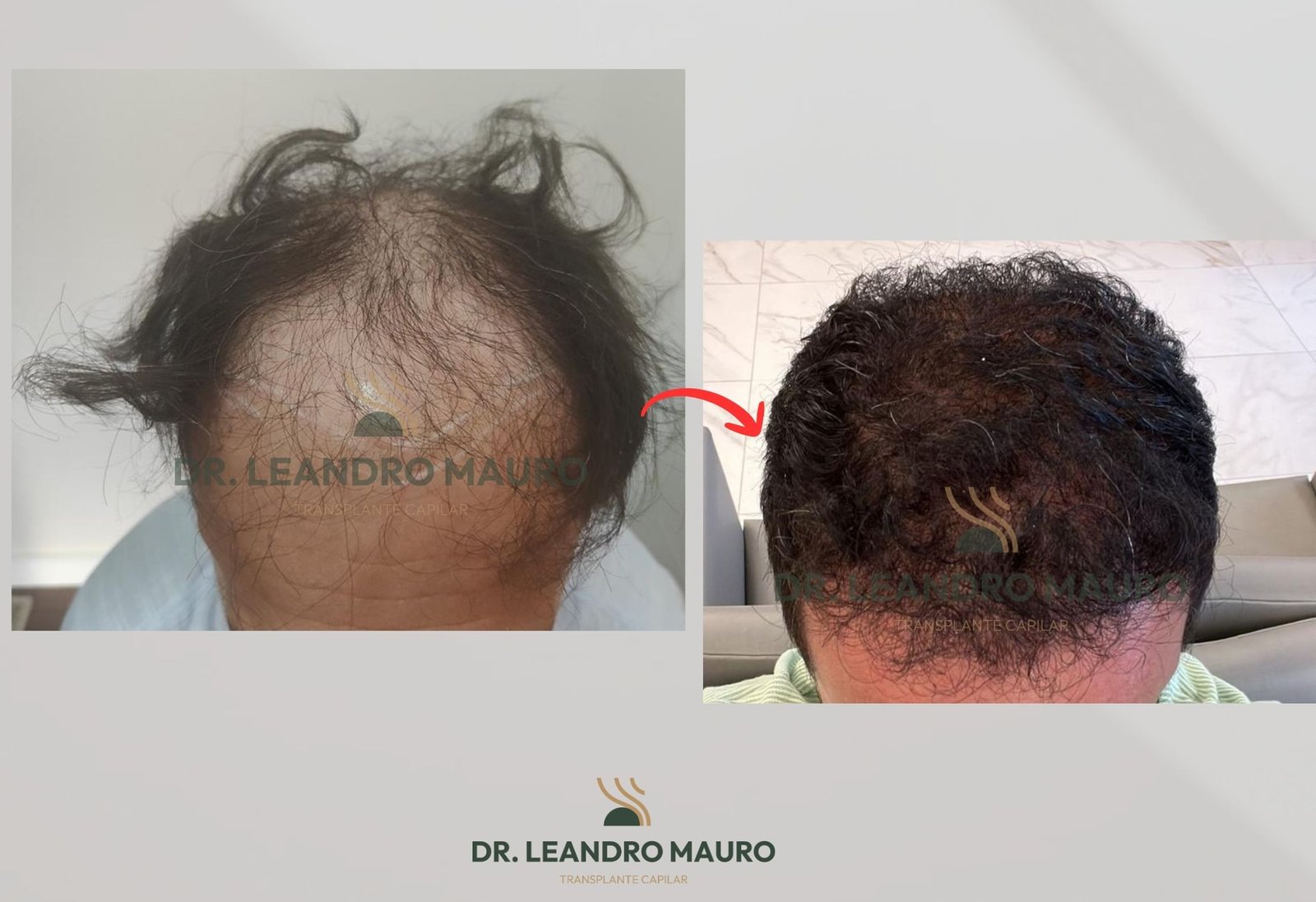 Implante Capilar Natural em Curitiba O Processo Completo com o Dr. Leandro Mauro