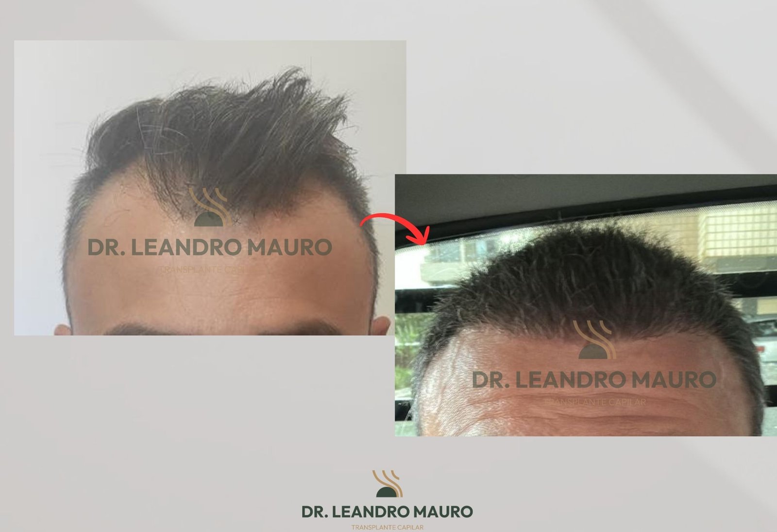 Linha Frontal Natural Como a Tecnica Especialista Eleva o Resultado do Transplante Capilar em Curitiba