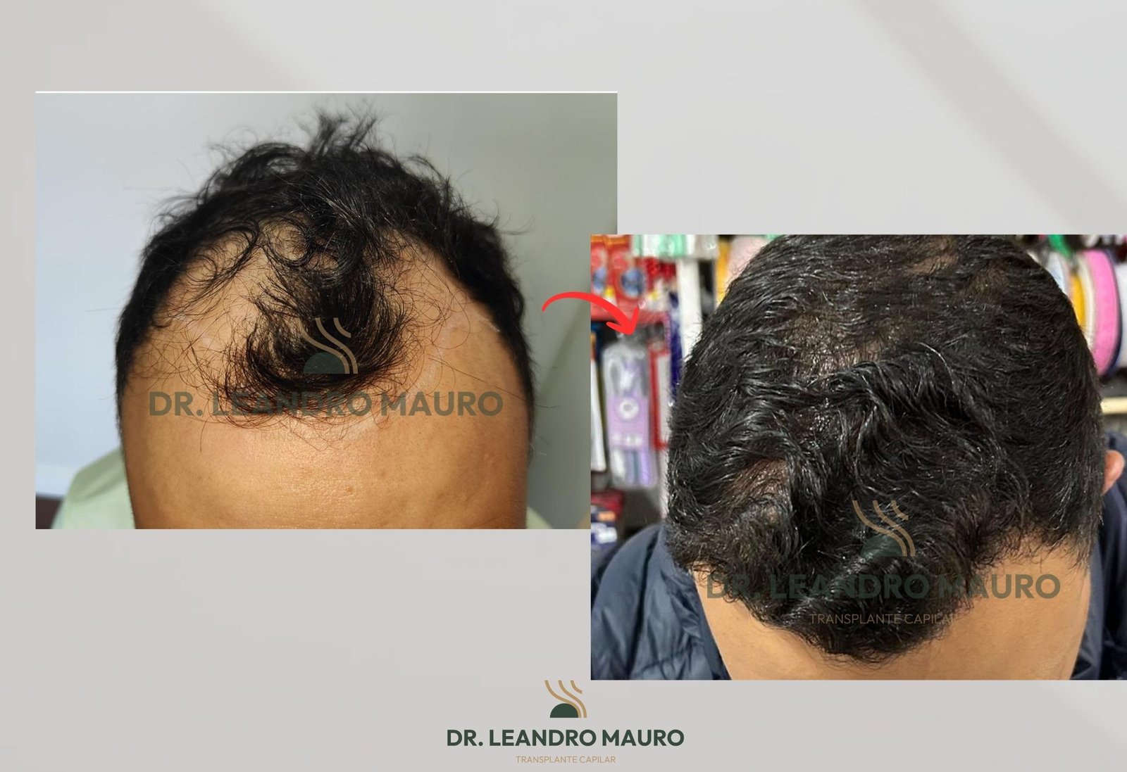 Queda de Cabelo e Calvicie Quando Procurar Transplante Capilar em Curitiba