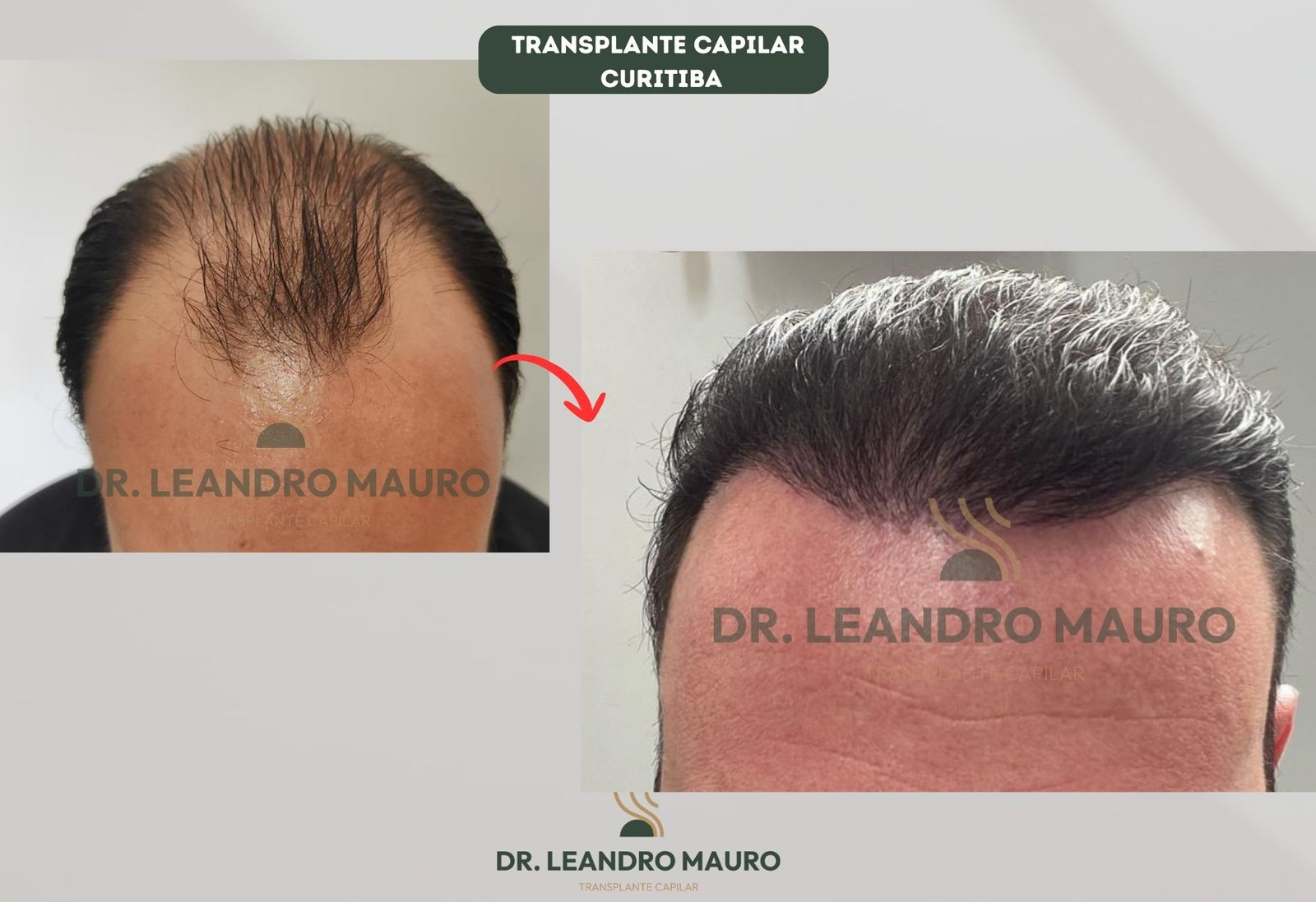 Transplante Capilar Masculino em Curitiba Resultados Consistentes e de Longo Prazo
