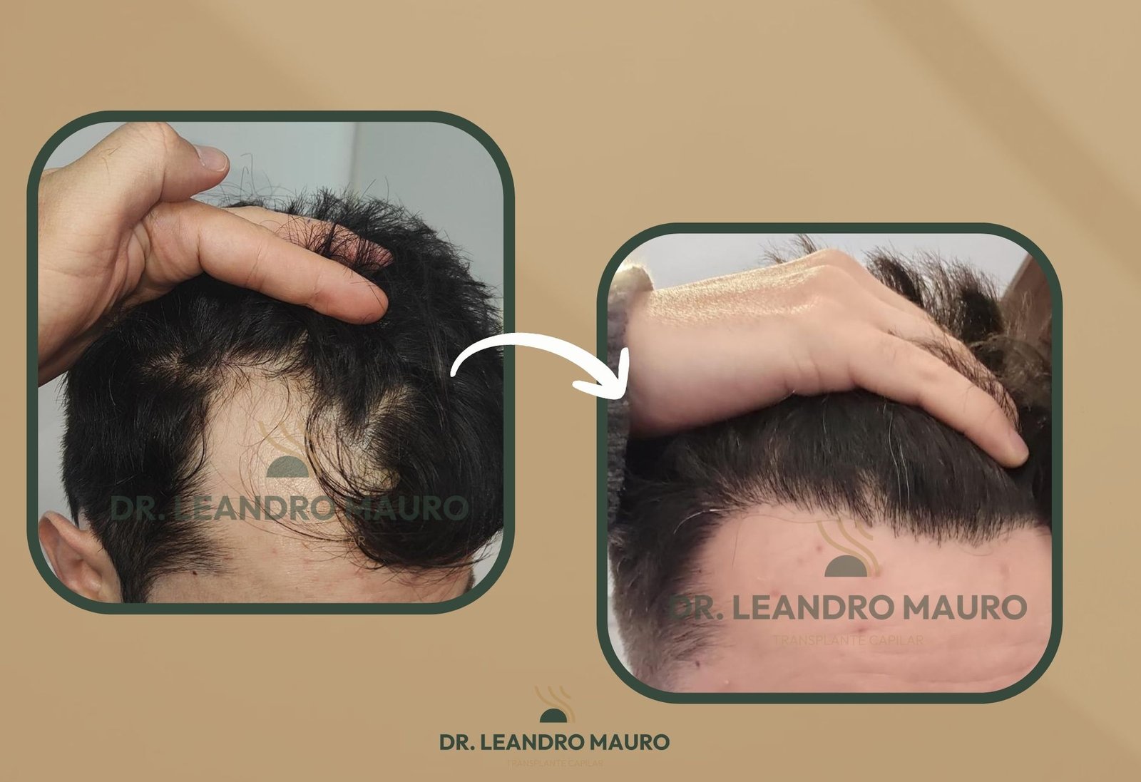 Transplante Capilar em Curitiba Como a Tecnica Especialista Garante Resultados Naturais