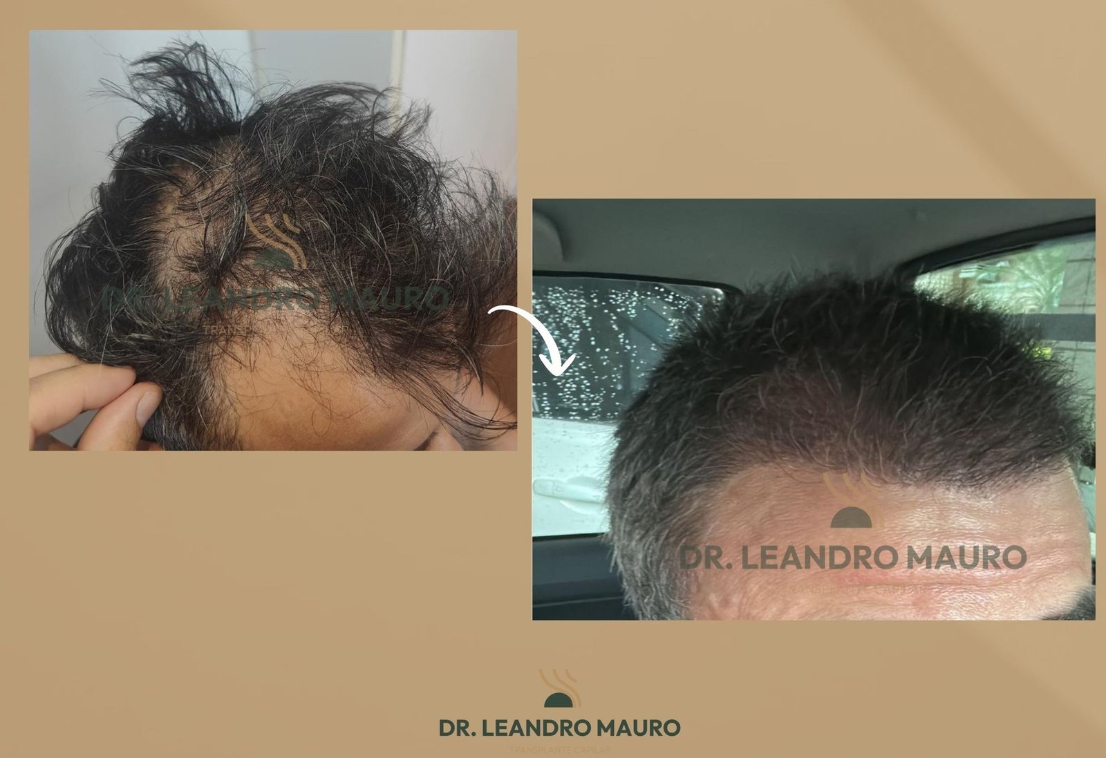 lTransplante Capilar em Curitiba Antes e Depois Tecnica Especialista e Resultados Naturais