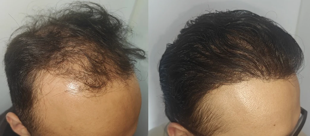 Comparação da região frontal e das entradas antes e depois do transplante capilar, em fotos lado a lado.